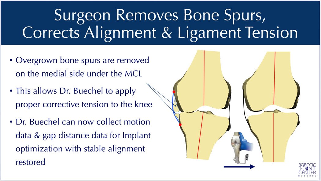 NYC Mako Robotic Partial Knee Replacement Dr Frederick Buechel Jr