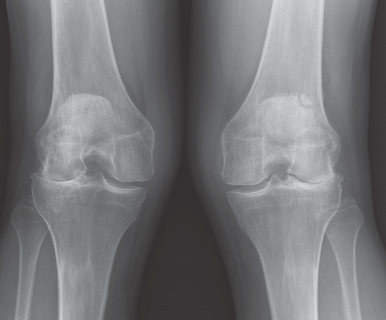 Nyc Lateral Partial Knee Replacement Robotic Partial Knee Replacement