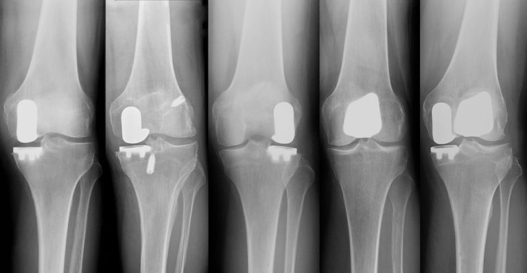 nyc-patellofemoral-partial-knee-replacement-robotic-partial-knee