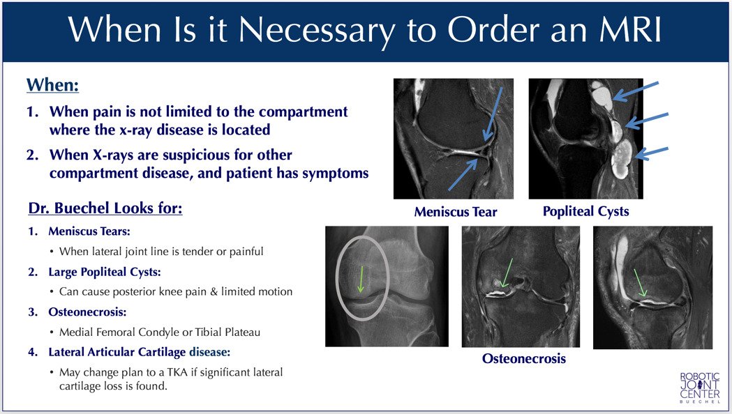 Nyc Mako Robotic Partial Knee Replacement 