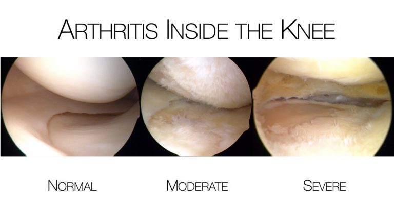 nyc-knee-osteoarthritis-treatment-causes-and-symptoms-of-knee