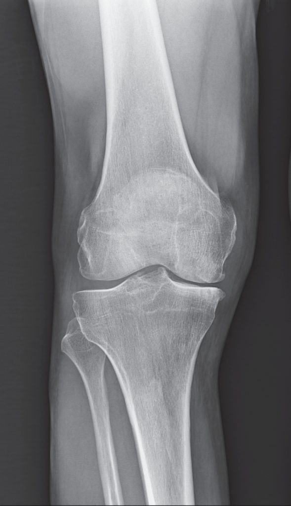 NYC Medial Partial Knee Replacement | Robotic Partial Knee Replacement