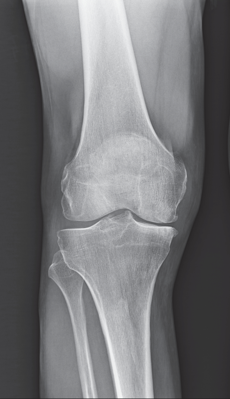 NYC Medial Partial Knee Replacement | Robotic Partial Knee Replacement