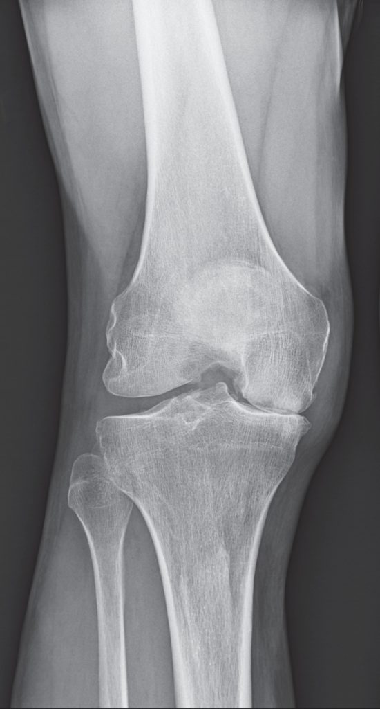 NYC Medial Partial Knee Replacement | Robotic Partial Knee Replacement