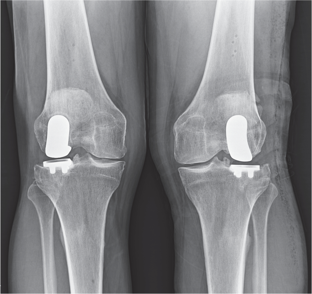 Nyc Lateral Partial Knee Replacement Robotic Partial Knee Replacement