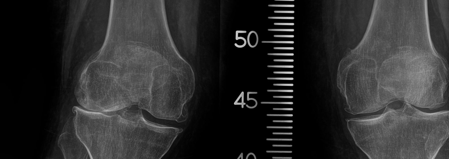 NYC Knee Osteonecrosis Treatment | What Is Knee Osteonecrosis (Bone ...